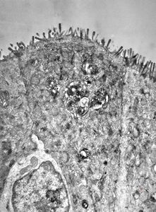 celiakia - invaded lymphocyte celiakia - invaded lymphocyte